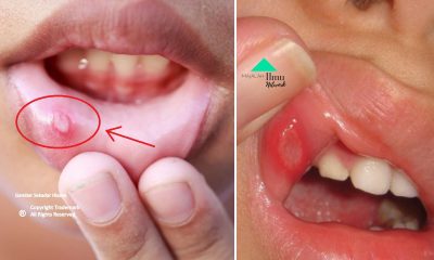 Rawatan Untuk Redakan Masalah Ulser Mulut Dengan Cepat